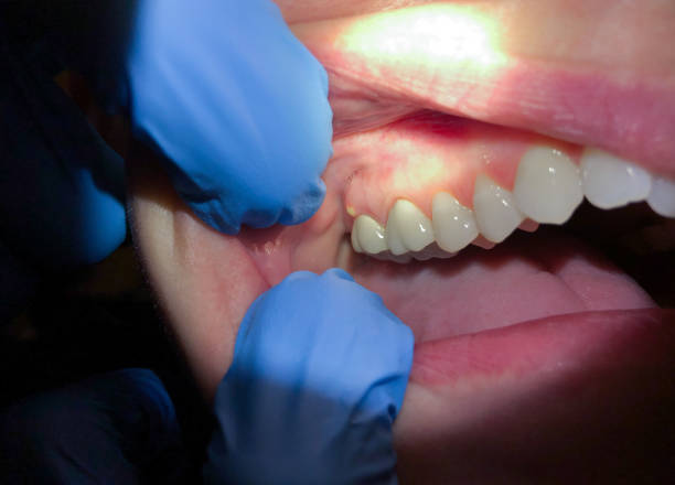 Best Emergency Treatment for Dental Infections or Abscesses in Lowell, MI